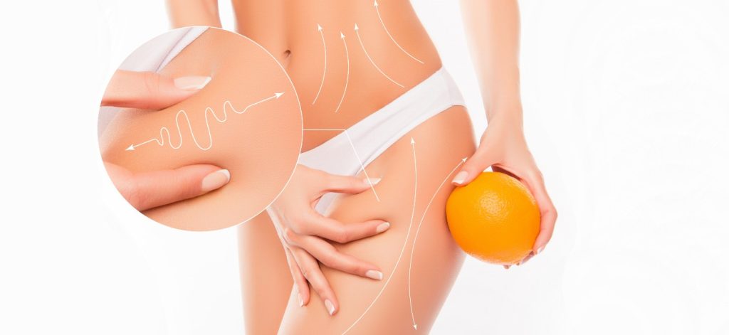 Cellulite, cause e rimedi - Più Medical