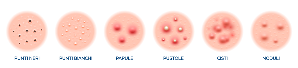 Tipologie di acne e pelle impura - Più Medical