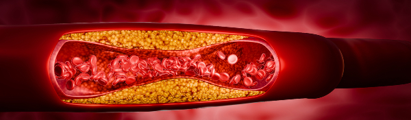 Concept per esame profilo lipidico completo: rappresentazione digitale di un'arteria occlusa